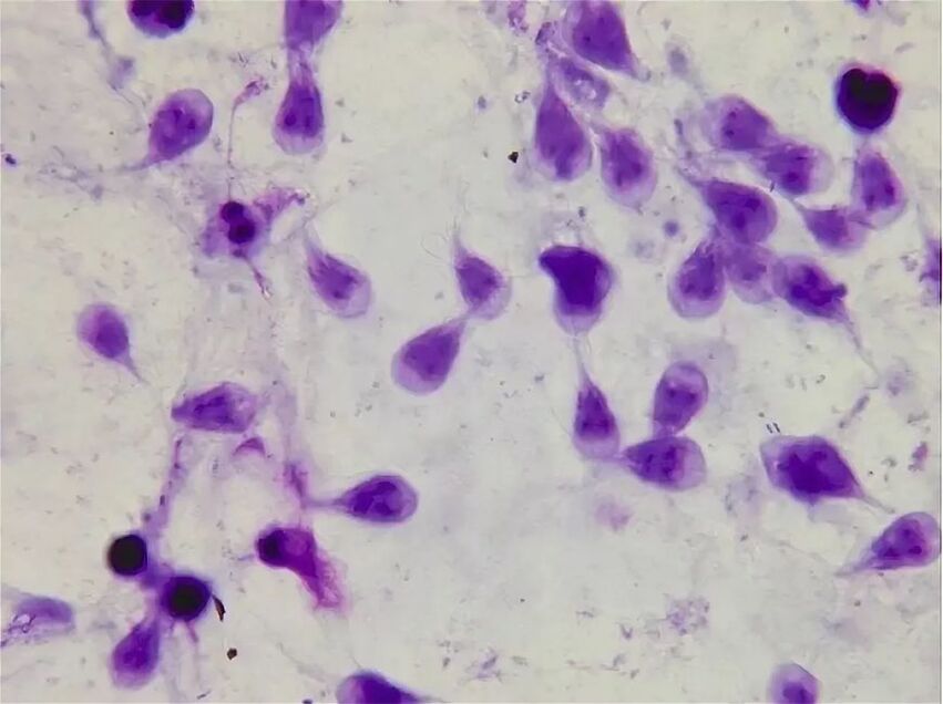 jak se zbavit lidské lamblie